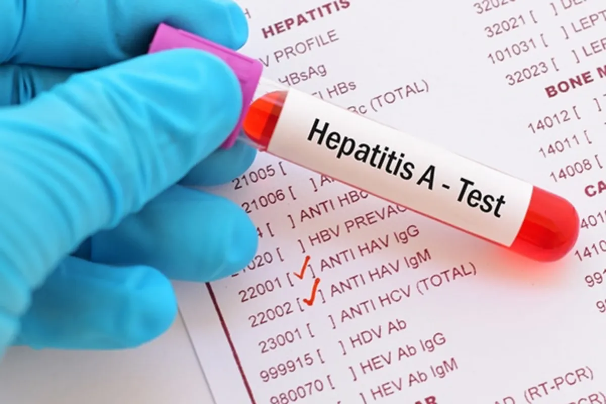 Hepatitis A
