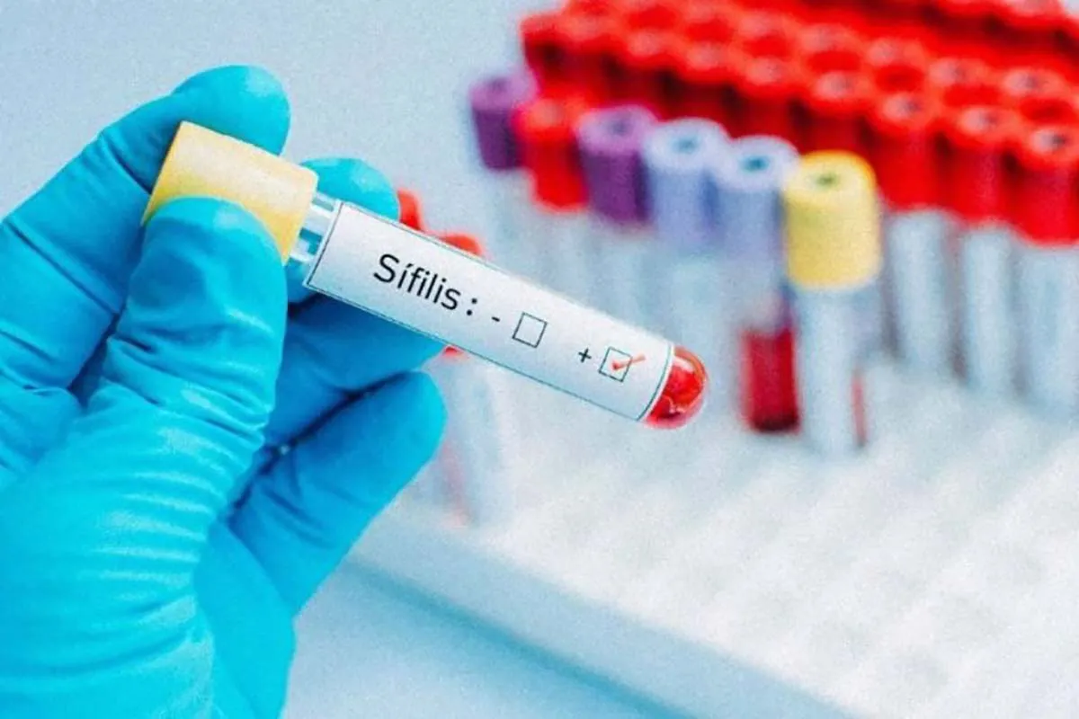 Sífilis