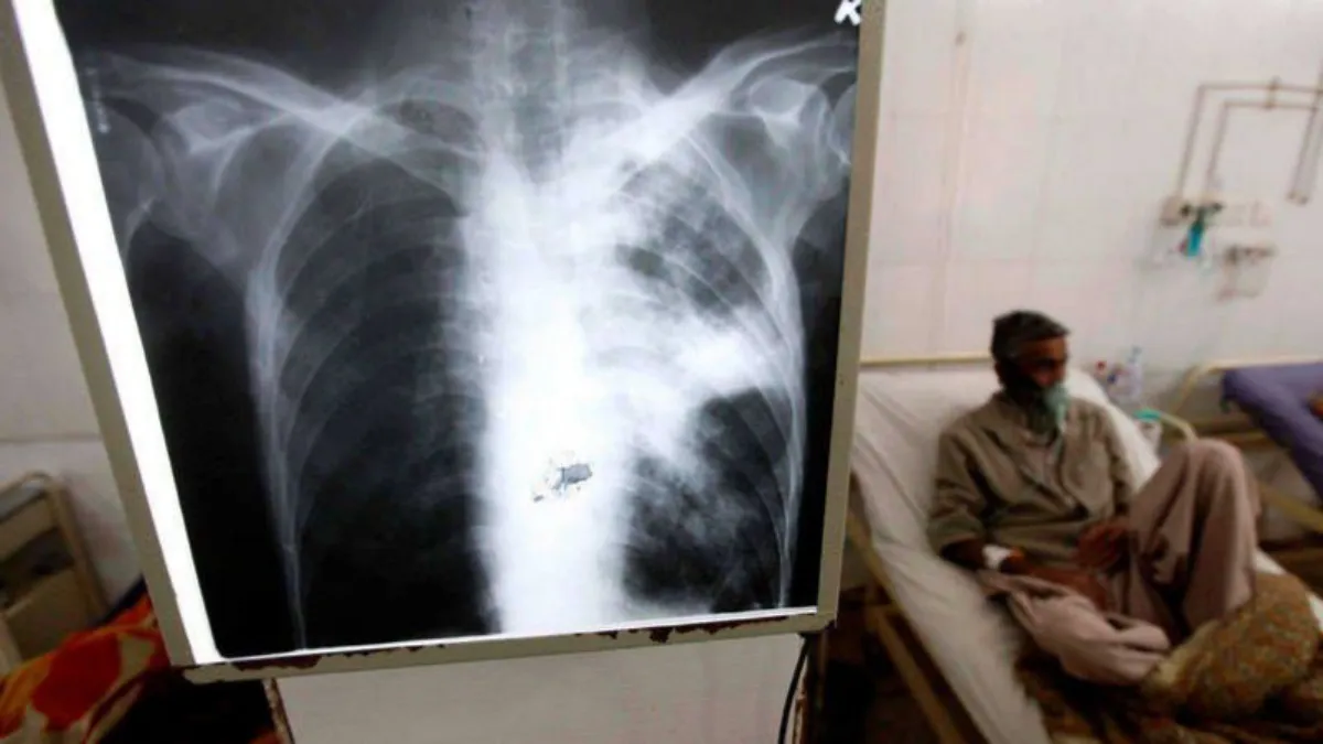 Tuberculosis